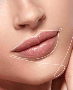hyacorp lips, redarea conturului buzelor