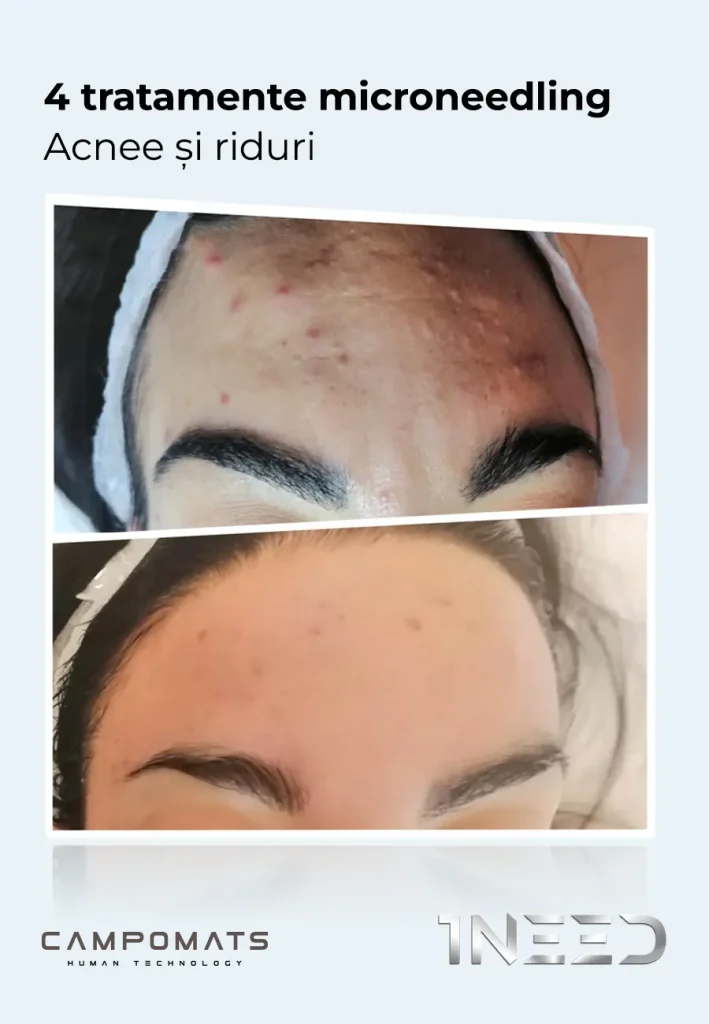 1NEED Pro Campomats, aparat microneedling medical și micropricking estetic aprobat FDA