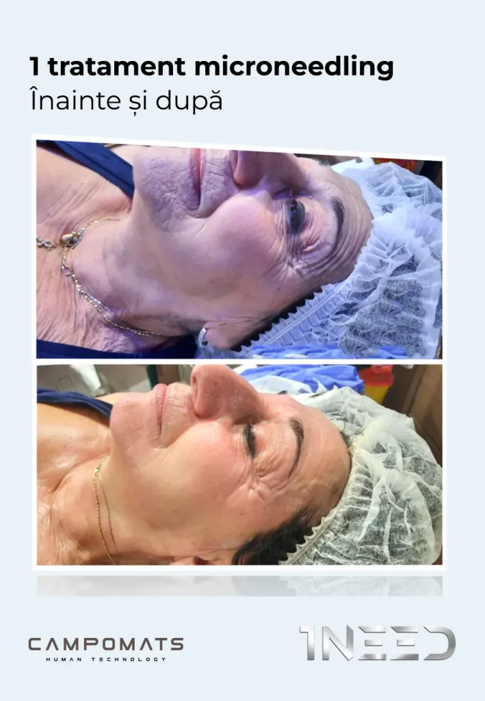 1NEED Pro Campomats, aparat microneedling medical și micropricking estetic aprobat FDA