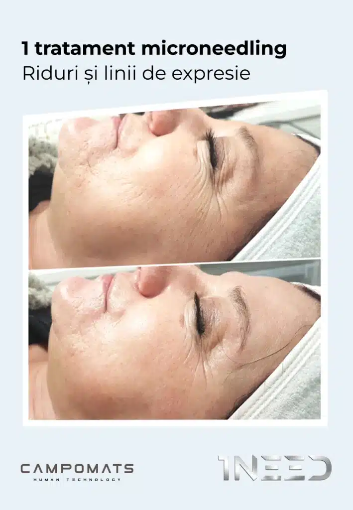 Rezultate în diminuarea ridurilor și liniilor de expresie După o singură ședință de microneedling se poate observa o îmbunătățire a aspectului pielii, cu diminuarea vizibilă a liniilor fine și o textură mai uniformă. Prin stimularea producției naturale de colagen și elastină, pielea își recapătă treptat fermitatea și elasticitatea, iar rezultatele continuă să evolueze în săptămânile următoare tratamentului.