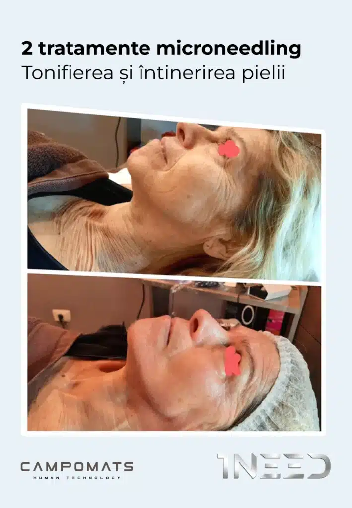 Rezultate în tonifierea și întinerirea pielii După două tratamente de microneedling, pielea poate căpăta un aspect mai ferm, mai luminos și mai uniform. Stimularea naturală a producției de colagen și elastină contribuie la îmbunătățirea elasticității pielii, estomparea liniilor fine și redarea unui aspect întinerit.