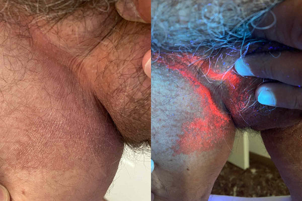 Lupă cu lampă profesională pentru examinarea pielii, Lumio 2 Dermlite